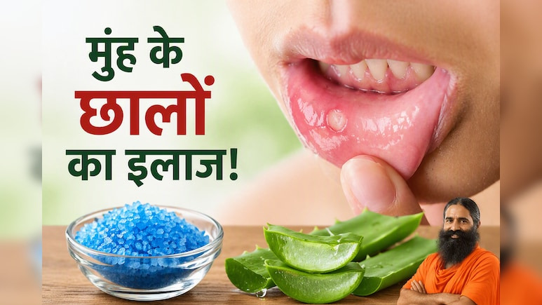मुंह के छालों से हैं परेशान? बाबा रामदेव ने बताया 2 मिनट का जादुई देसी नुस्खा